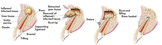 apicoectomy