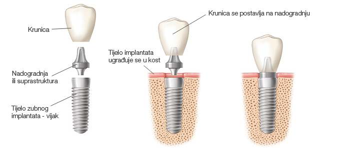 dentalni-implantat