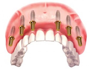 dentalni implantati all on 6