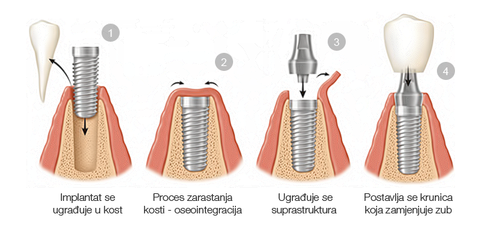 postupak-ugradnje-implantata